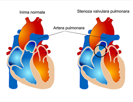 stenoza-valvulara-pulmonara-1