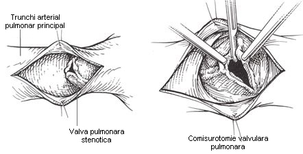 stenoza-valvulara-pulmonara-2