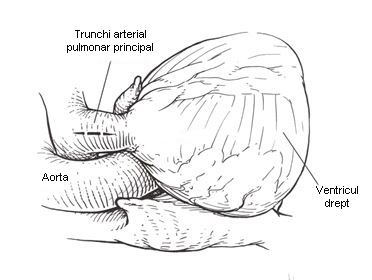 stenoza-valvulara-pulmonara-3
