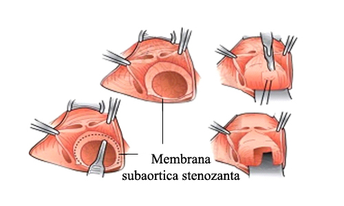 stenozele-aortice4