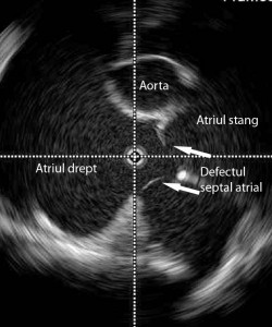 1_defect_septal_atrial_eco_intracardiac