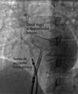 3_implant_proteza_eco_intracardiac