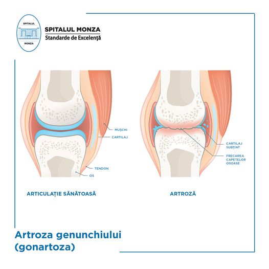 tratament la nivelul genunchiului biliar o durere de șold la exteriorul articulației șoldului