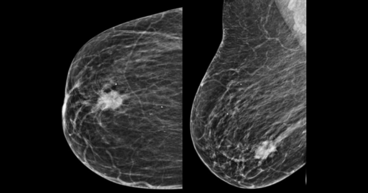 cancer mamar ecografie platyhelminthes classe cestoda